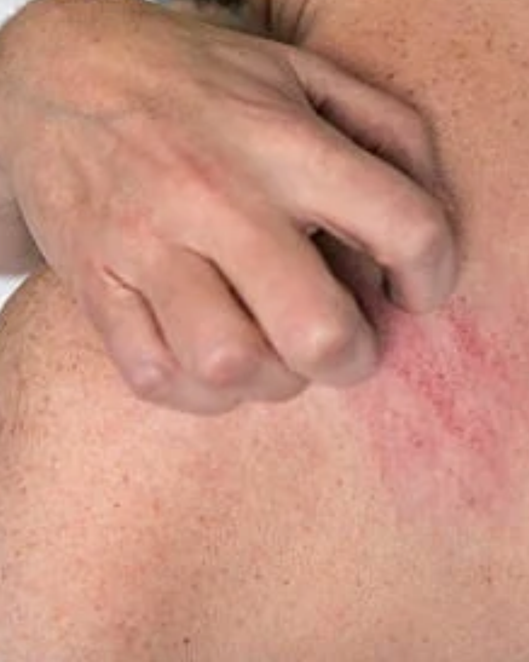 Lagoa Santa contabiliza 191 casos de sarna humana BH e Sul de Minas