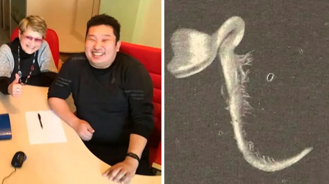 Homem descobre planta crescendo dentro do olho após acidente durante férias