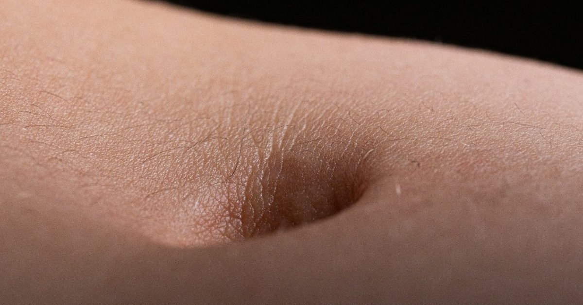 Cicatriz escondida: como a abdominoplastia aprendeu a disfarçar o umbigo