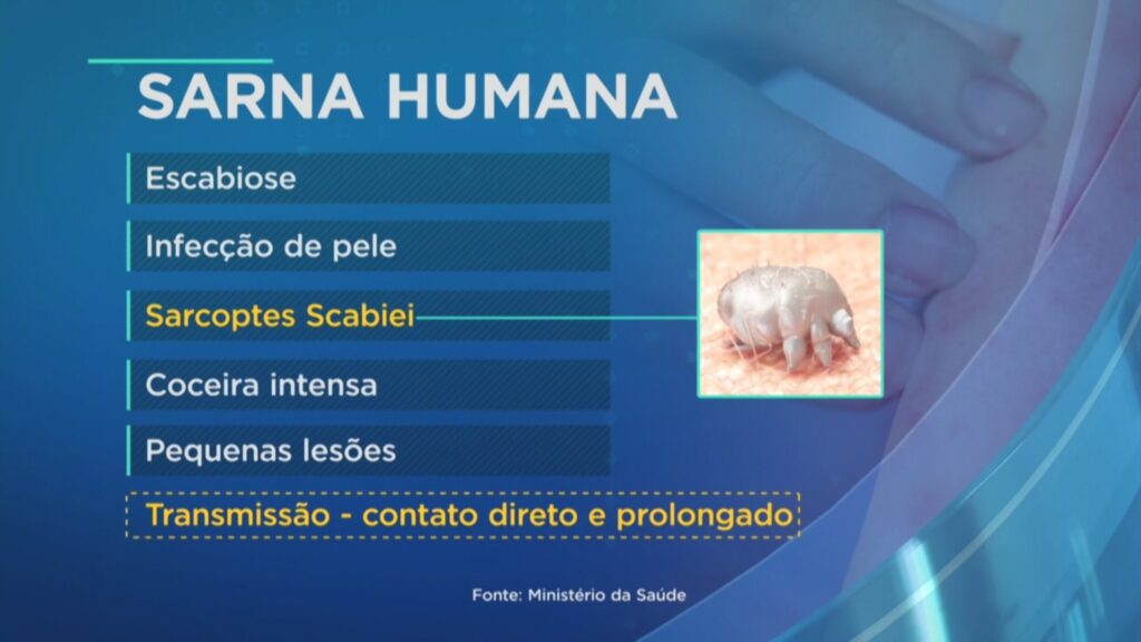 Surtos de sarna humana atingem nove cidades de Minas Gerais